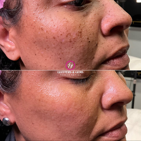 Sunspot Removal