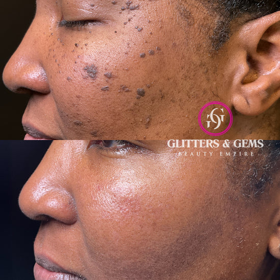 Seborrheic Keratosis and other Skin Growth Removal